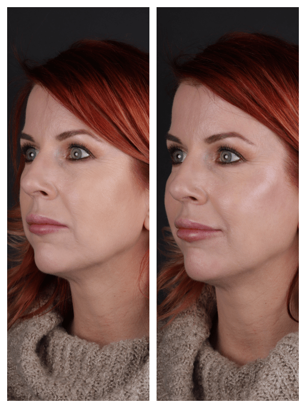 efter fillers