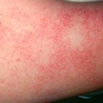 keratosis pilaris