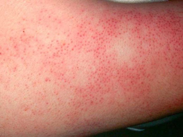 keratosis pilaris